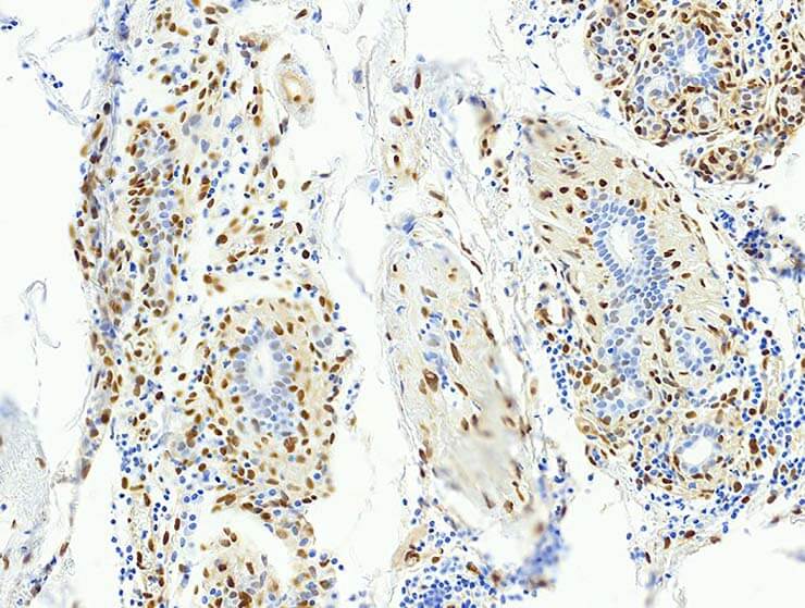 Example breast cancer tissue IHC image result