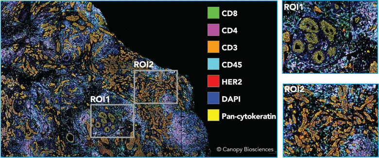 Highly multiplexed image of breast cancer sample. A 21-plex antibody panel was applied to a HER2+ breast carcinoma tissue specimen. Shown above is a subset of biomarkers highlighting tissue architecture and identifying immune cells.