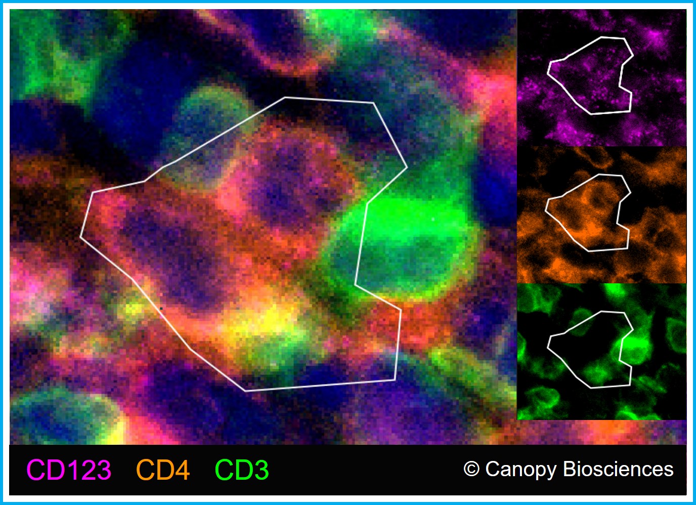 Identification of plasmacytoid dendritic cells characterized as CD3- CD123+ CD4+.