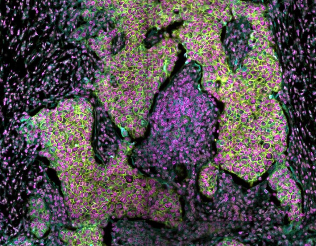 Human_FFPE_Breast_Cancer
