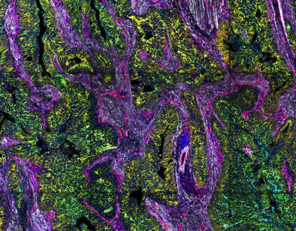 Human_FFPE_Colorectal_Cancer2