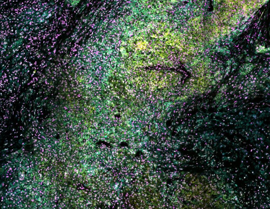 Human_FFPE_Melanoma