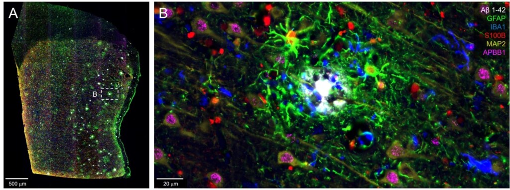 Brain tissue section + zoomed in region with multicolored neurons and a white plaque in the center.