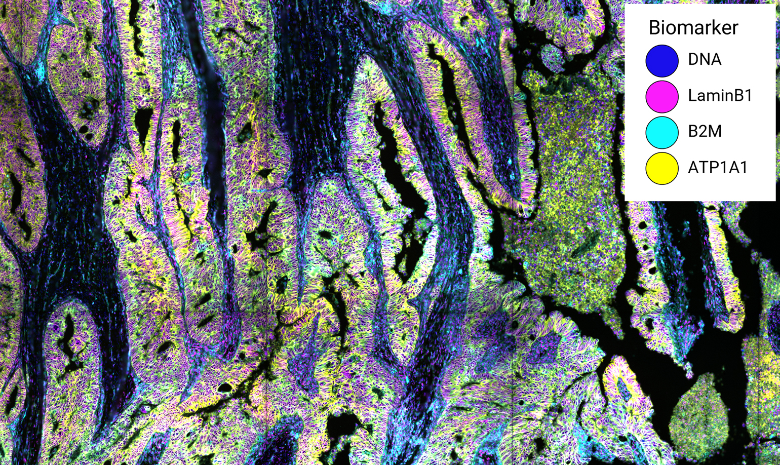 Fluorescent multiplex IHC image of human colon cancer tissue, labeled with four structural biomarkers. Pseudocolored signals show DNA (blue), LaminB1 (magenta), B2M (cyan), and ATP1A1 (yellow), outlining cell nuclei, nuclear membranes, and cell boundaries to reveal tissue architecture and organization.
