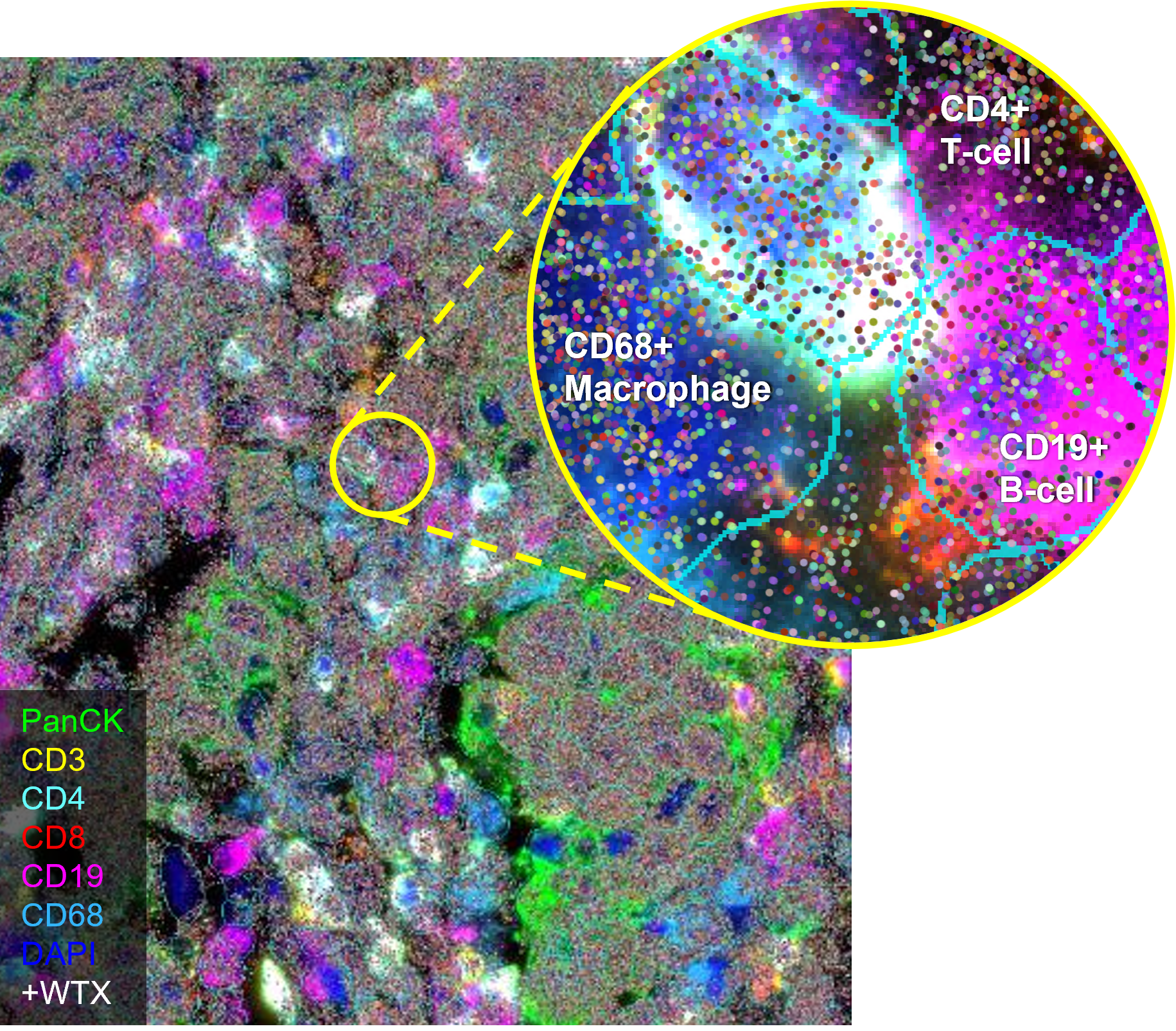 Fluorescent tissue image with CosMx protein markers, with inset zoomed in to show whole-transcriptome with single-cell resolution