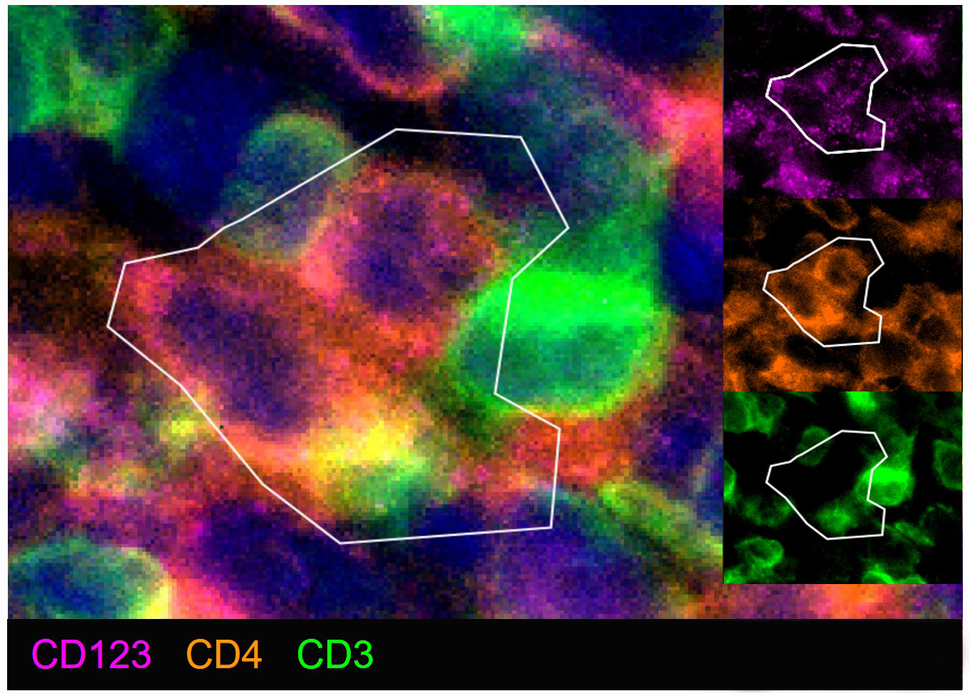 Identification of plasmacytoid dendritic cells characterized as CD3- CD123+ CD4+.