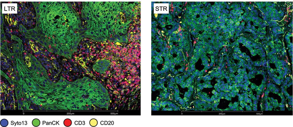 Fluorescent images of two tumors with Syto13, PanCK, CD3, and CD20 shown