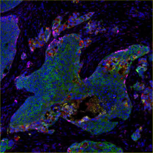 Multiplexed protein imaging of human squamous cell carcinoma tissue.
