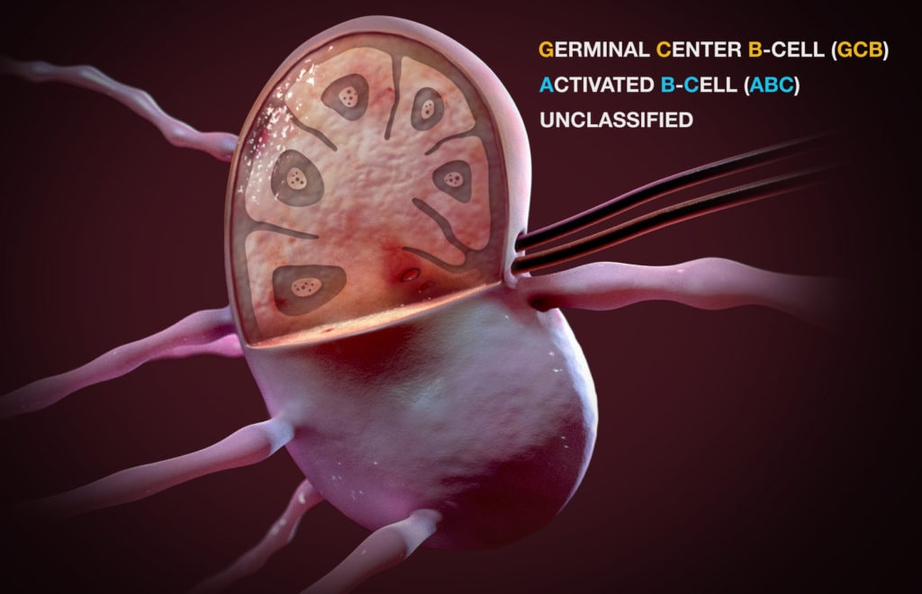 Cell of origin subtypes in Diffuse Large B-Cell Lymphoma
