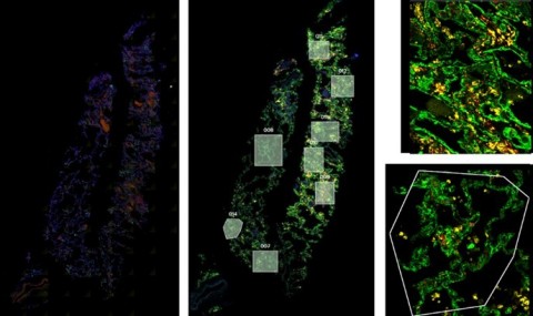 RNAScope (left) was utilized to assess the SARS-CoV-2 viral load of autopsy samples, and inform a strategy for region of interest selection (middle). Regions showing noteworthy biology were selected and segmented on CD45 and CD68 to focus on specific structures within the tissues (right). (Graphic: Business Wire)