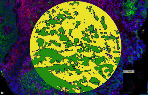 GeoMx Digital Spatial Profiler tissue image with tumor/stroma AOIs superimposed. (Graphic: Business Wire)