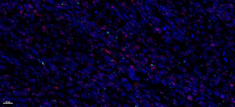 RNAscope&trade; multiplex fluorescent visualization of cervical cancer. (Graphic: Business Wire)